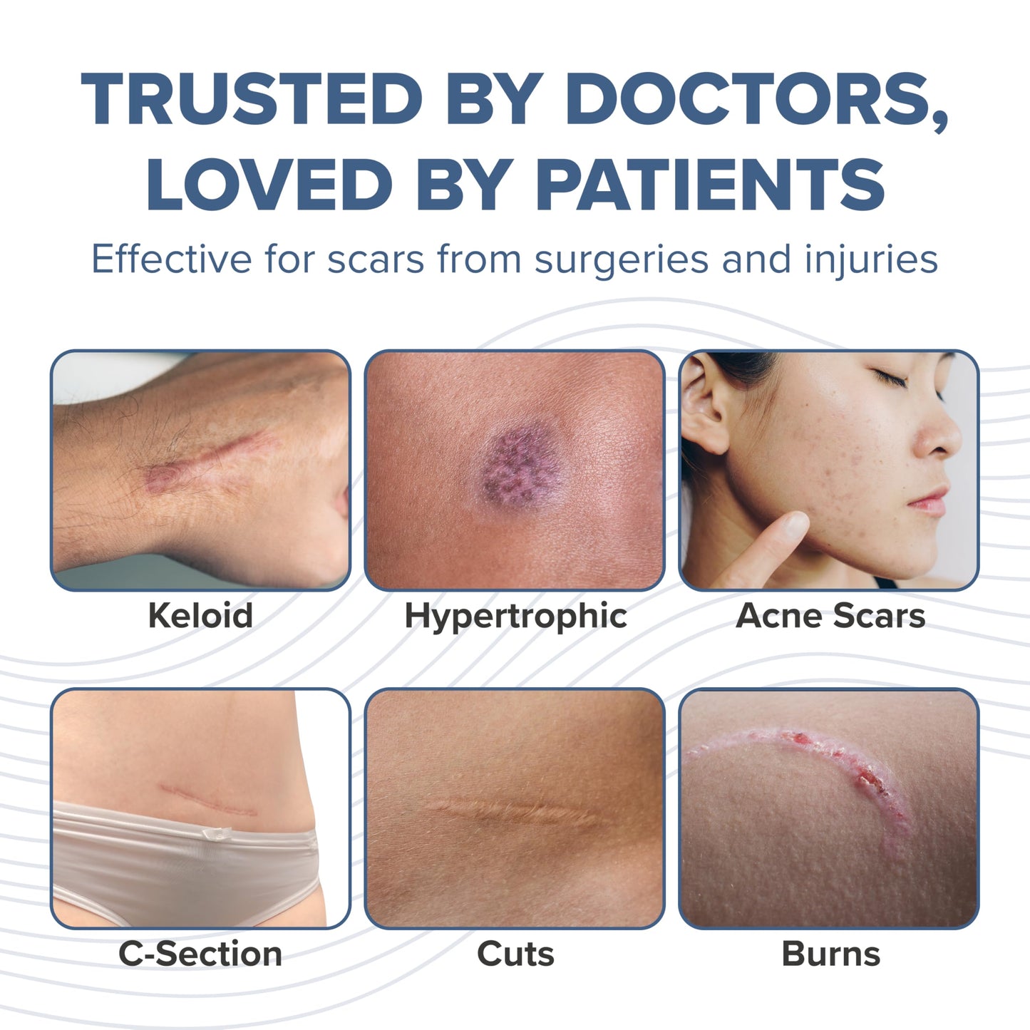 BIODERMIS ProSIL Silicone Scar Stick – Non-Invasive Scar Gel for Surgical, Acne & Burn Scars (17g)