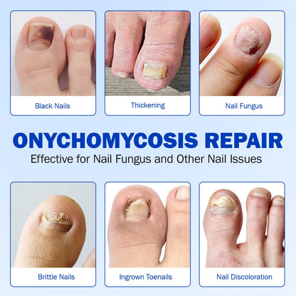 Cacukn Toenail Treatment Extra Strength – 2 Pack Nail Repair Patches (42 Pcs) | Overnight Renewal