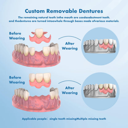 Custom Removable Dentures – Personalized Partial Denture Set for Tooth Replacement | 1–Multi-Tooth Coverage with Storage Case | Comfortable Wear for teeth (5 Teeth)