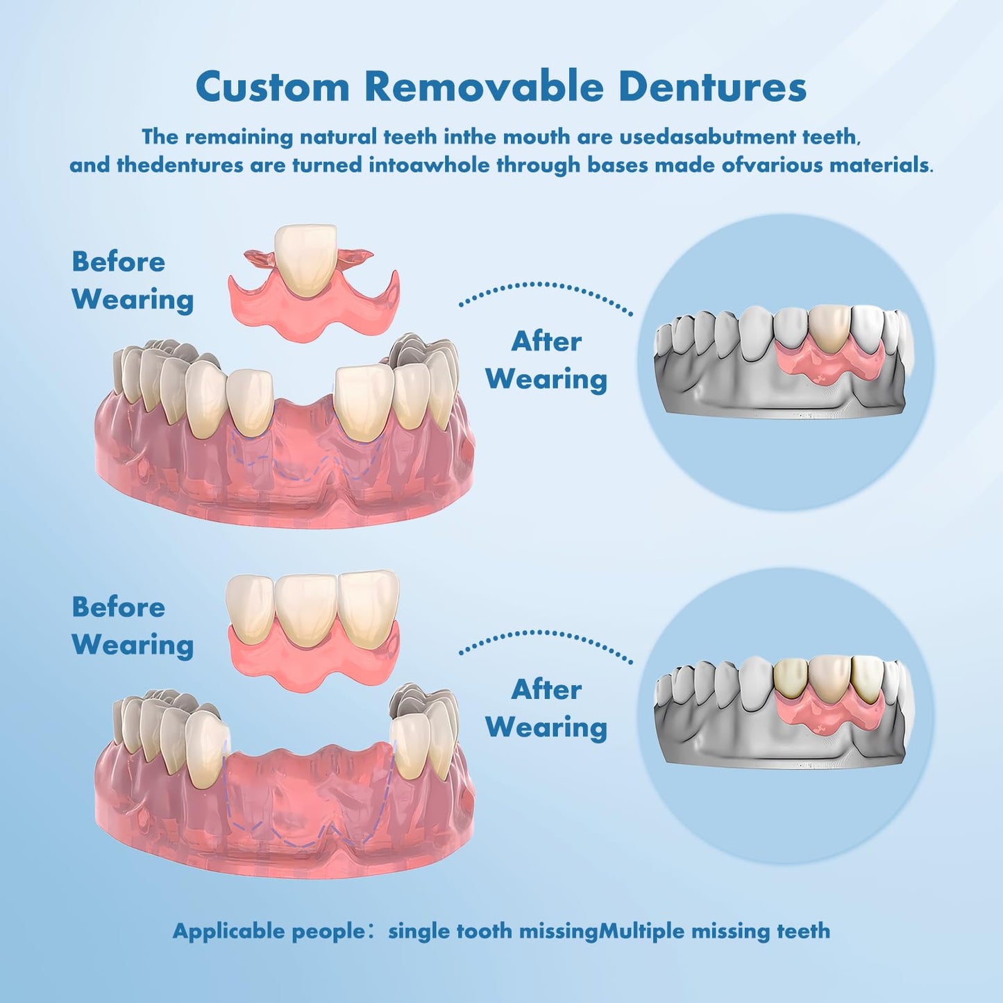Custom Removable Dentures – Personalized Partial Denture Set for Tooth Replacement | 1–Multi-Tooth Coverage with Storage Case | Comfortable Wear