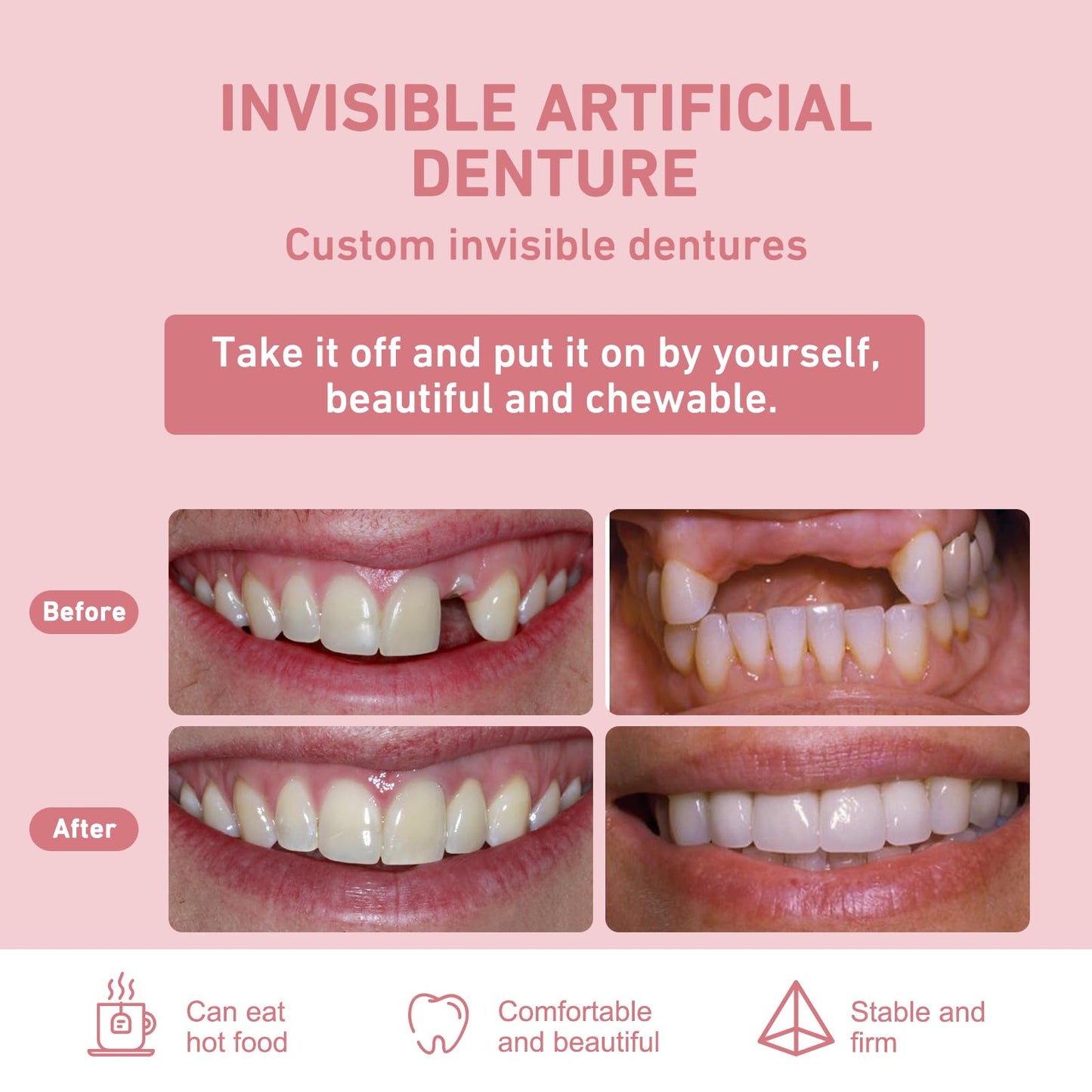 Custom Partial Dentures – Personalized Removable Denture Set for Missing Teeth | 1–6 Tooth Replacement with Storage Case | Natural Look & Comfortable Fit (4 Teeth)