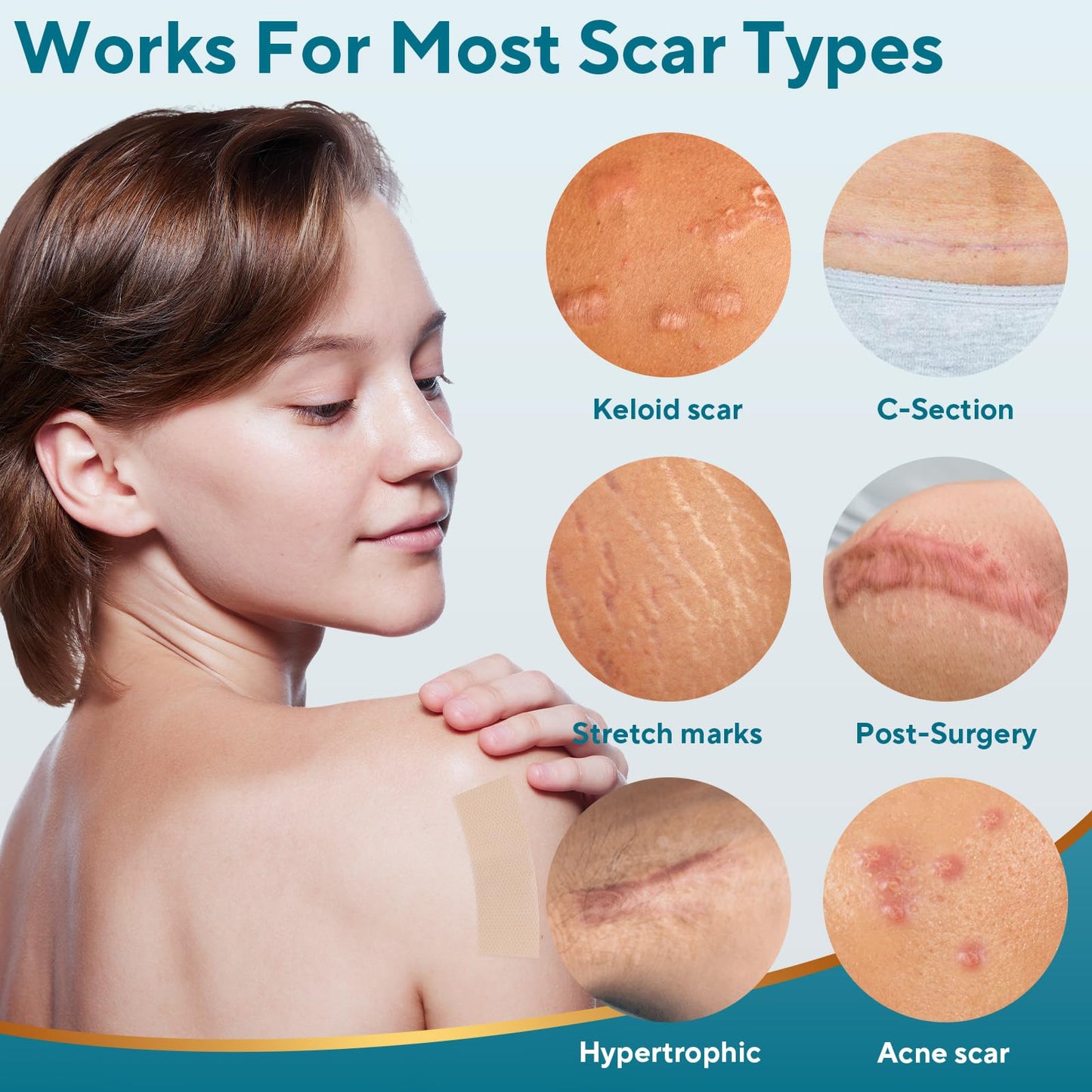 GIATENL Silicone Scar Sheets Roll – Reusable Scar Tape for Surgical Scars, Keloids, C-Section (1.5m)