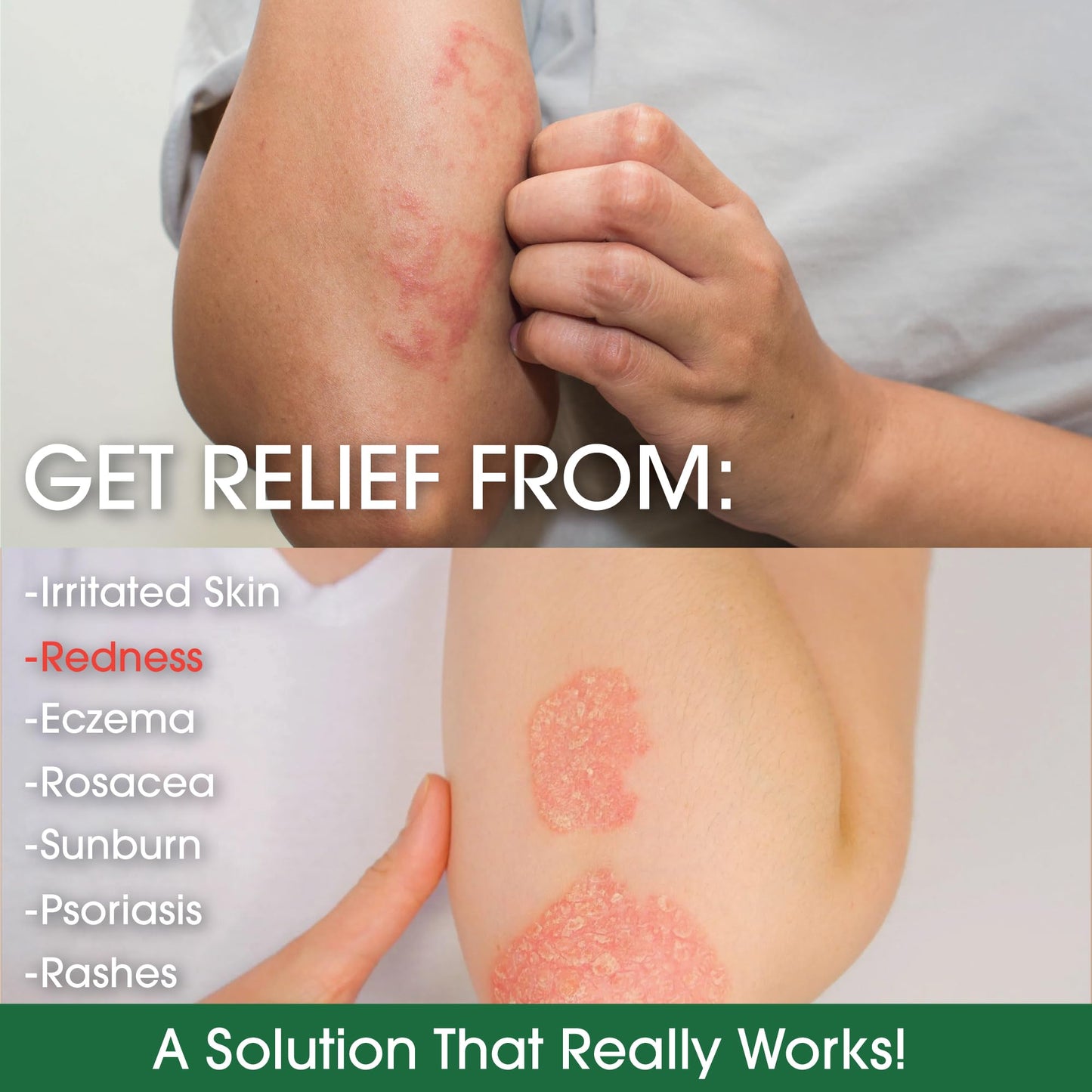 Manuka Honey Eczema Cream Moisturizing Lotion Treatment for Psoriasis Relief - Itchy, Dry Skin Rash Ointment - Soothing Moisturizer for Baby, Kids, Adults - High Strength Body & Face Cream 2oz