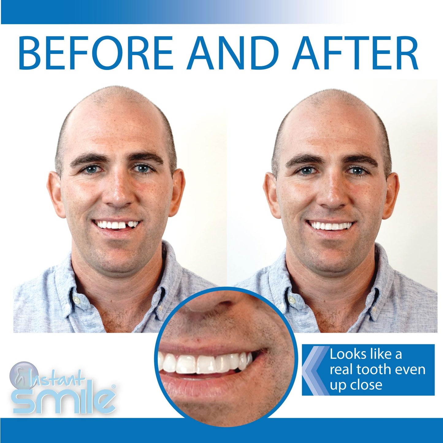 Instant Smile Pro Series Temporary Tooth Kit – At-Home Replacement