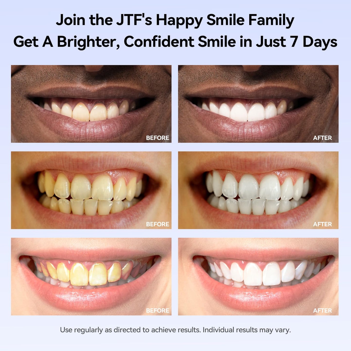 JTF Portable Teeth Whitening Kit – LED Light, 35% Carbamide Peroxide, 5 Gels + 1 Remineralization Gel