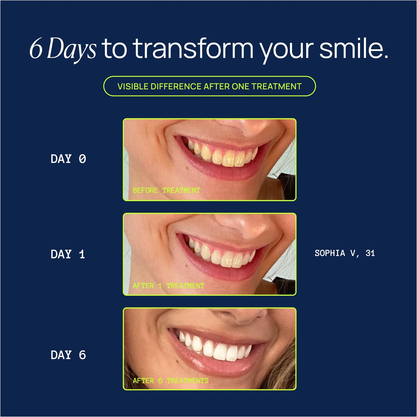 Laughland Super Strength Teeth Whitening Kit – Phone-Powered LED Mouthpiece