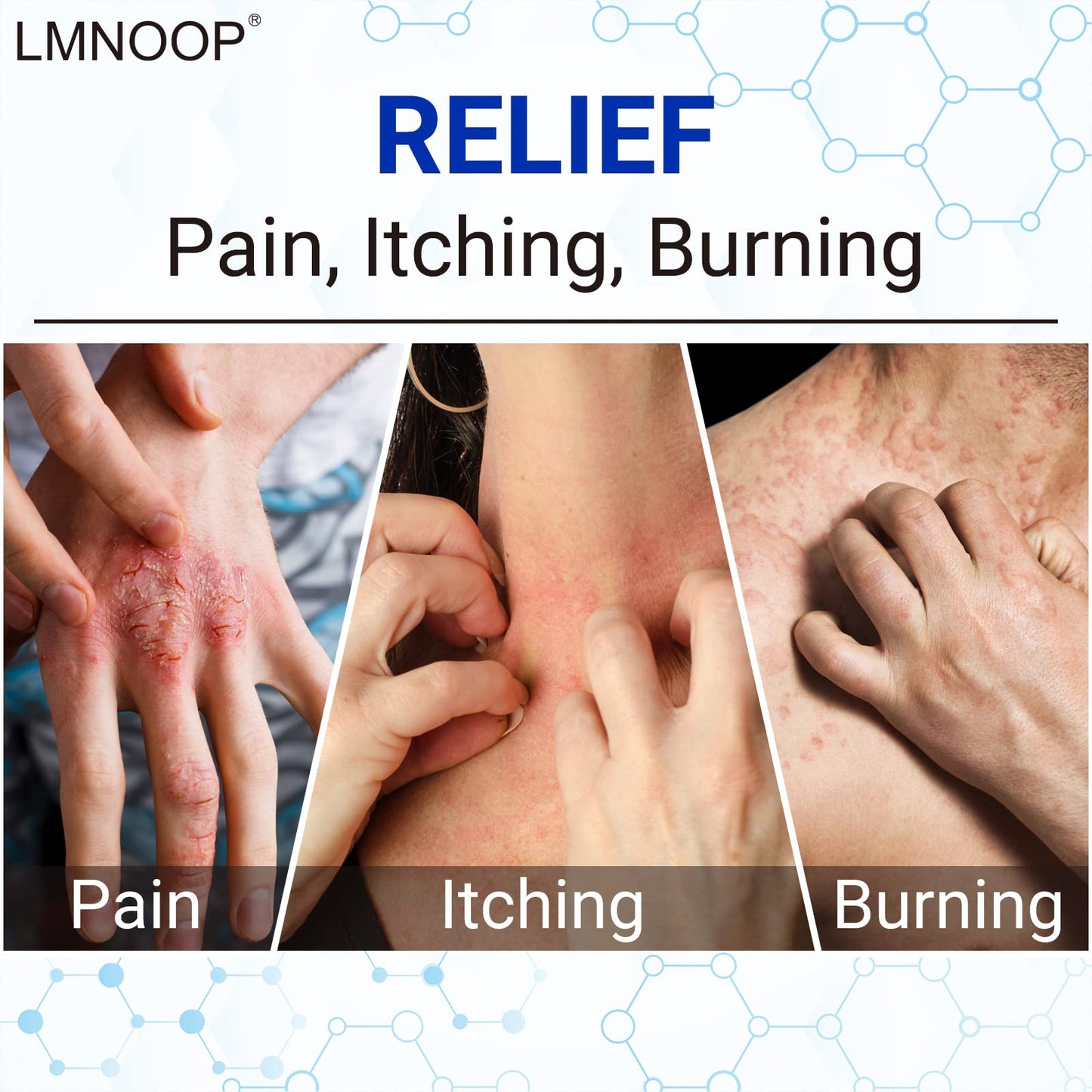 LMNOOP Eczema Cream | Maximum Strength Relief for Itchy, Dry Skin (1.76 oz)