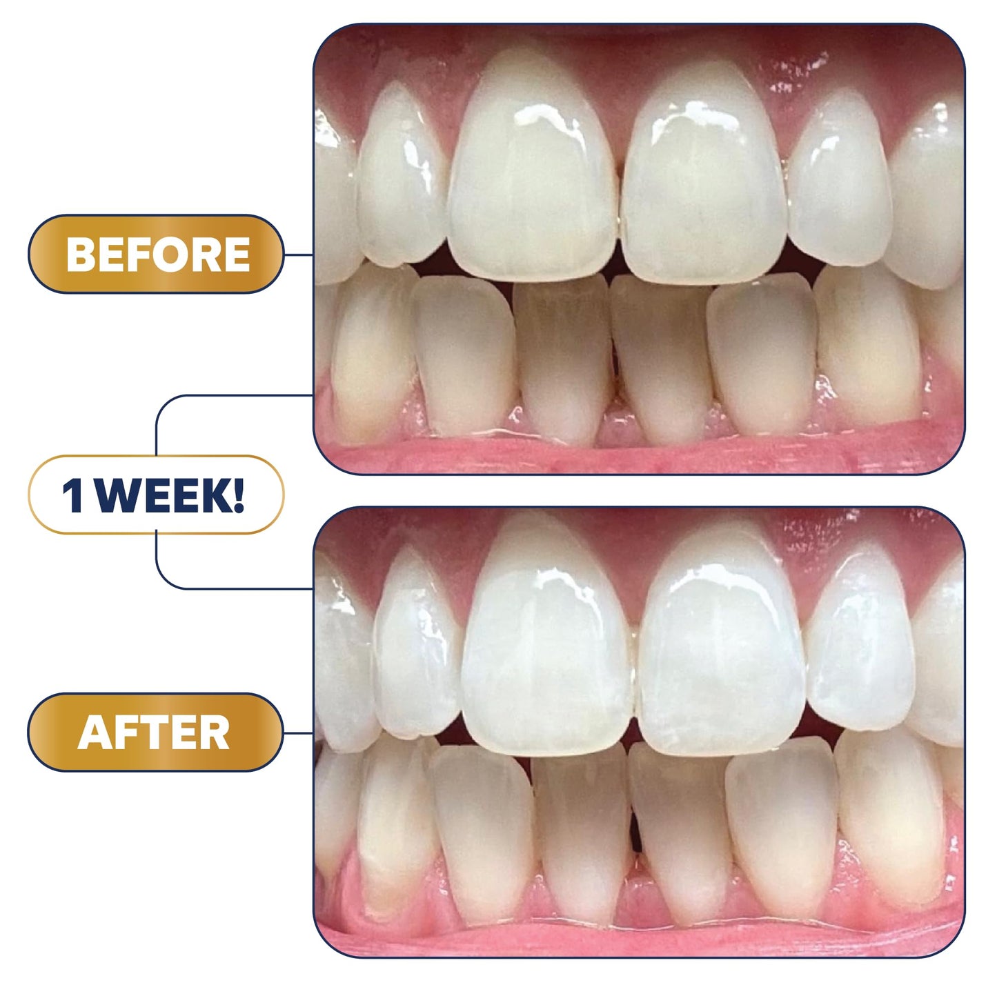 Lumineux Ultimate Whitening Kit Bundle – Enamel Safe & Clinically Proven