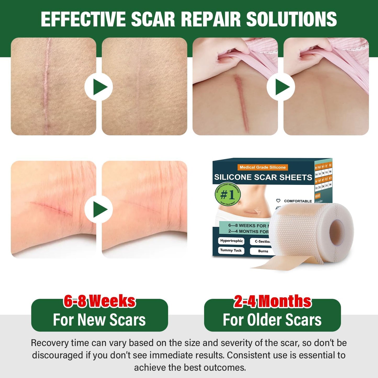 Mitreal Silicone Scar Sheets – 1.6x120 Roll | Surgical Scar Tape