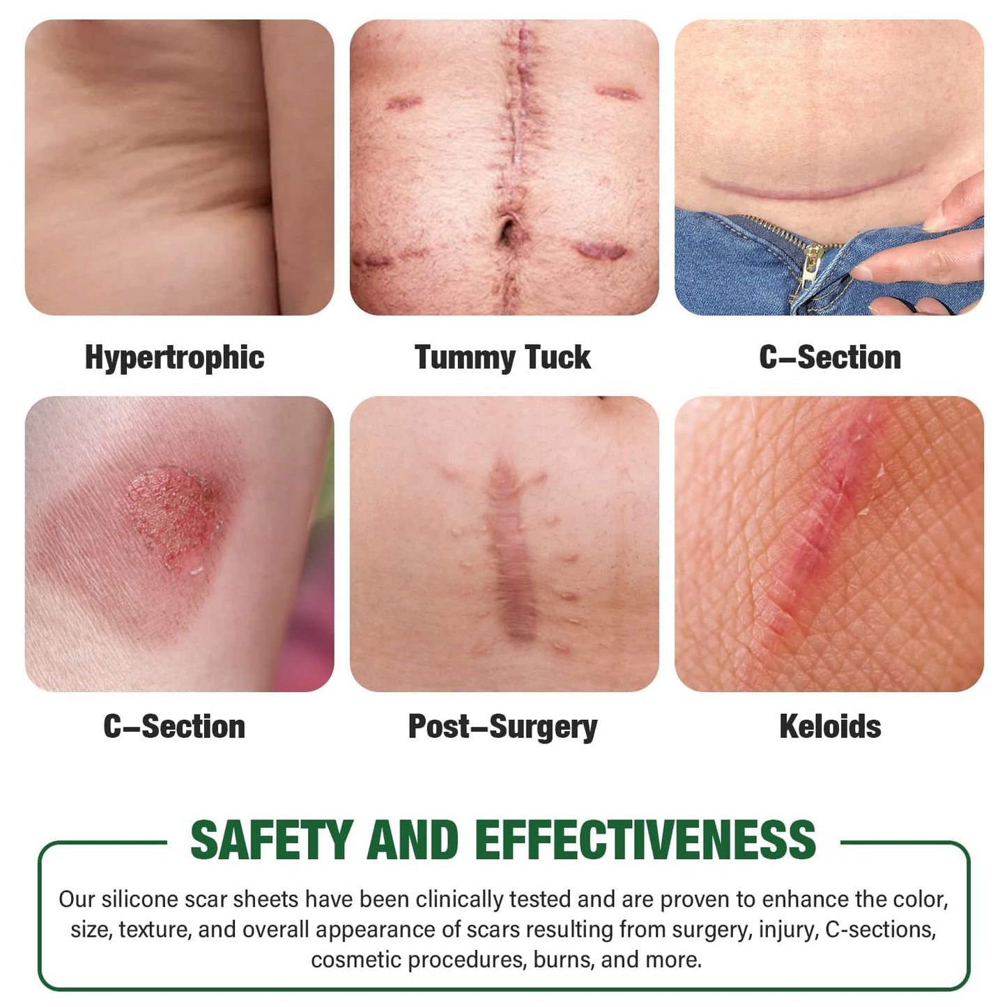 Mitreal Silicone Scar Sheets – 1.6x120 Roll | Surgical Scar Tape