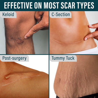 NUVADERMIS Silicone Scar Sheets - 120x1-5 Roll - Medical-Grade Scar Tape for Surgical Scars Wrinkles and Keloids