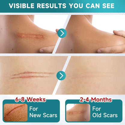 Pumkot Silicone Scar Sheets & Tape – 1.6”x60” Roll for Surgical Scars, C-Section & Burns