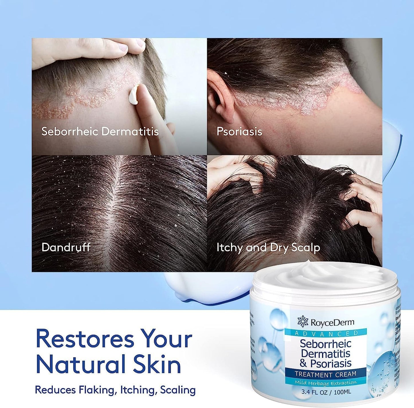 Roycederm Seborrheic Dermatitis Cream | Scalp Treatment for Psoriasis, Dandruff, Dry Scalp - 2 Pack