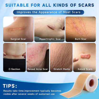 Rvlaim Silicone Scar Sheets Tape Roll 1.6” x 60” – Breathable, Reusable Scar Care for Surgical Scars, Keloids, Stretch Marks