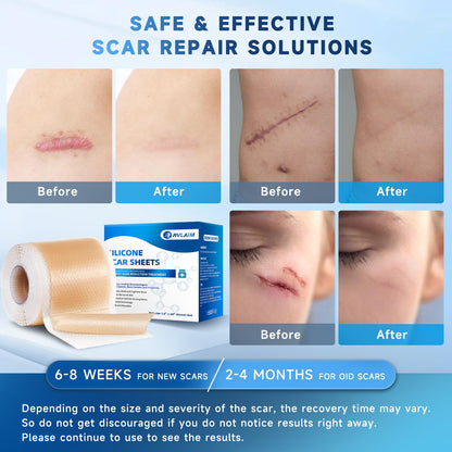 Rvlaim Silicone Scar Sheets Tape Roll 1.6” x 60” – Breathable, Reusable Scar Care for Surgical Scars, Keloids, Stretch Marks