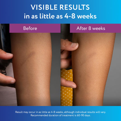ScarAway Silicone Scar Gel – Improve Size, Color & Texture of Hypertrophic & Keloid Scars (10g)