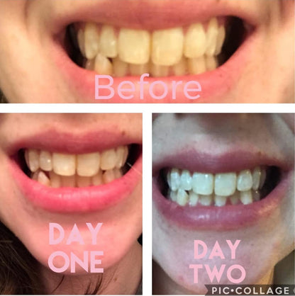 Smile Titan Whitening Gel Refill – 4x Syringes, 44% CP