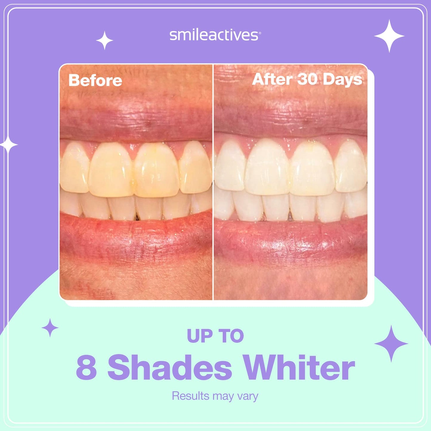 Smileactives Prolite LED Teeth Whitening Kit – At-Home Whitening