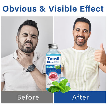 Tonsil Stone Remover Mouthwash 2-Pack – Soothe Tonsils & Fresh Breath