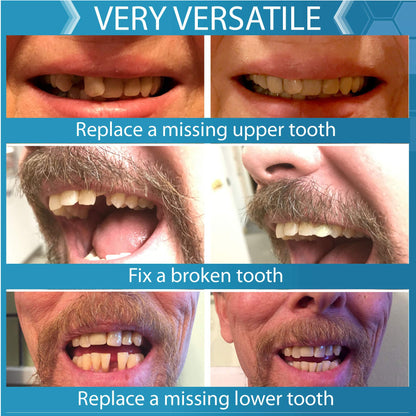 Complete Your Smile Deluxe Tooth Replacement Kit with Beads